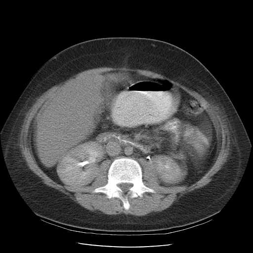 File:Non-Hodgkin lymphoma involving pelvis (Radiopaedia 21281-21197 B 33).jpg
