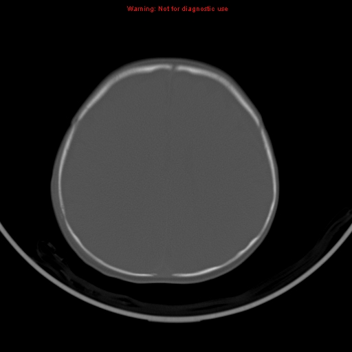 File:Non-accidental injury - bilateral subdural with acute blood (Radiopaedia 10236-10765 Axial bone window 16).jpg