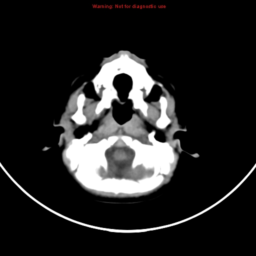 File:Non-accidental injury - bilateral subdural with acute blood (Radiopaedia 10236-10765 Axial non-contrast 2).jpg