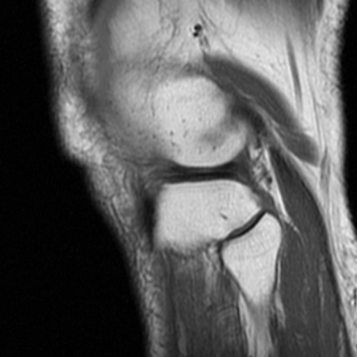 File:Non-displaced patella fracture (Radiopaedia 15932-15582 Sagittal T1 17).jpg
