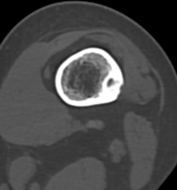 Non-ossifying fibroma - femur (Radiopaedia 82786-97042 Axial bone window 39).jpg