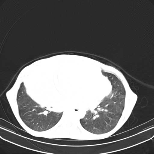 File:Non hodgkin lymphoma of the mediastinum (Radiopaedia 20814-20729 Axial lung window 33).jpg