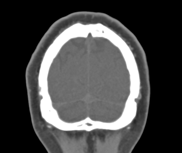 File:Normal CTA head (Radiopaedia 40801-43464 B 86).png