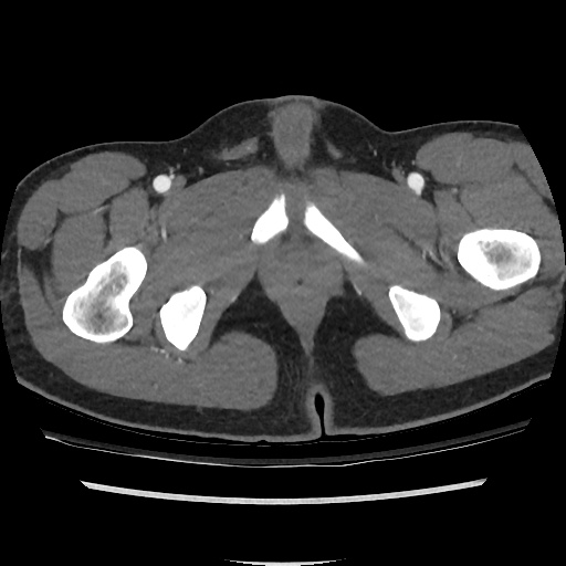 File:Normal CT angiogram of pelvis (Radiopaedia 45390-49430 A 55).jpg