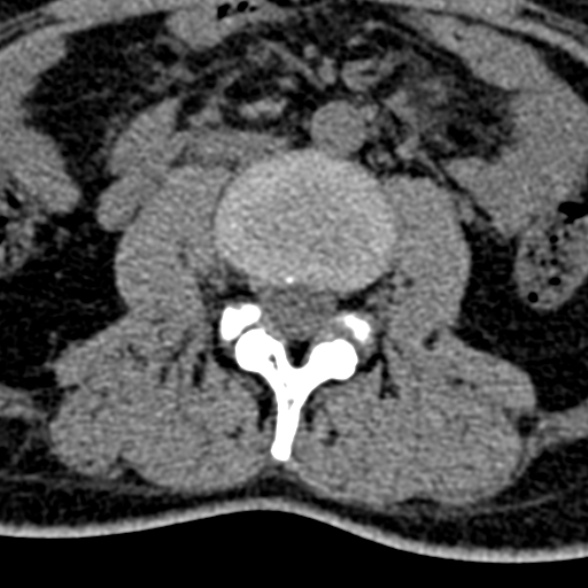 Normal CT lumbar spine (Radiopaedia 53981-60118 Axial non-contrast 55).jpg