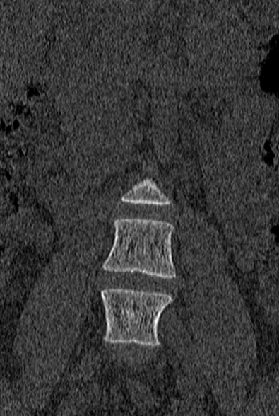 Normal CT lumbar spine (Radiopaedia 53981-60118 Coronal bone window 7).jpg