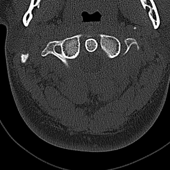File:Normal CT of the cervical spine (Radiopaedia 53322-59305 Axial bone window 65).jpg