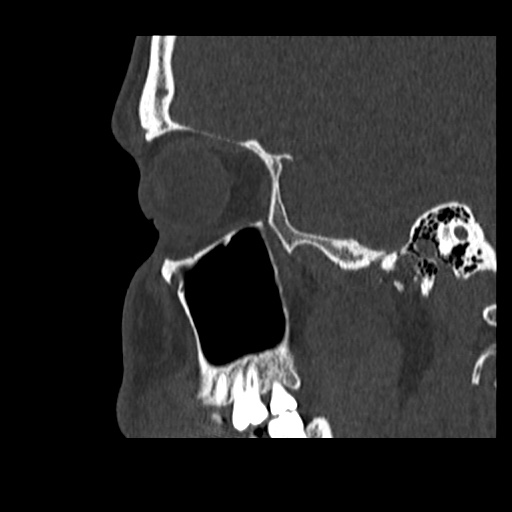 Normal CT paranasal sinuses (Radiopaedia 42286-45390 Sagittal bone window 22).jpg