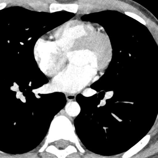 File:Normal CT pulmonary veins (pre RF ablation) (Radiopaedia 41748-44702 A 180).png
