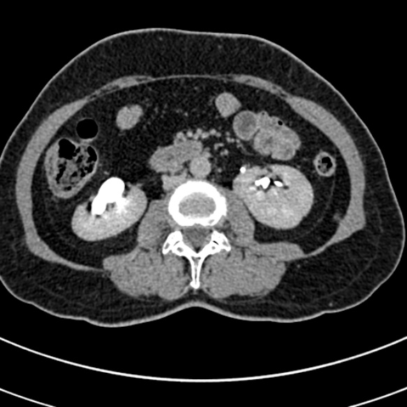 File:Normal CT split bolus study of the renal tract (Radiopaedia 48631-53634 Axial split bolus 115).jpg