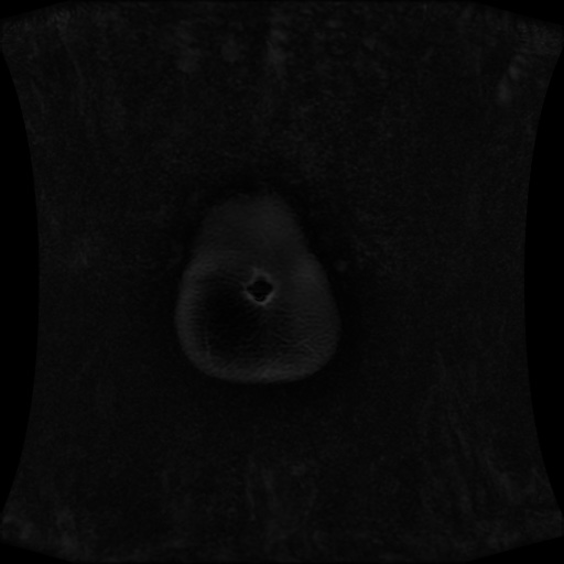 Normal MRI abdomen in pregnancy (Radiopaedia 88001-104541 M 10).jpg