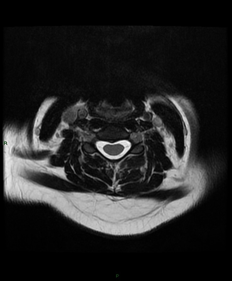Normal cervical spine MRI (Radiopaedia 80146-93454 Axial T2 46).jpg