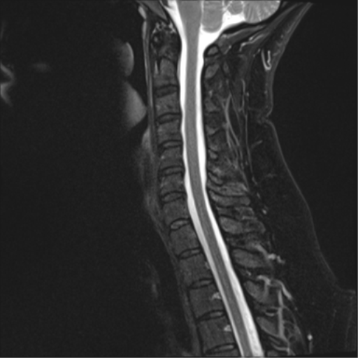File:Normal cervical spine MRI (including Dixon) (Radiopaedia 42762-45925 Dixon- Water 9).png