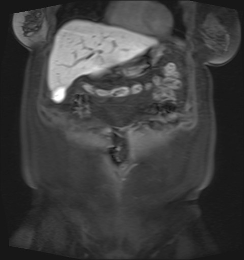 File:Normal hepatobiliary phase liver MRI (Radiopaedia 58968-66230 B 41).jpg