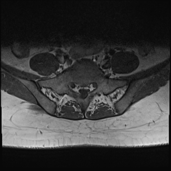 File:Normal lumbar spine MRI- 3 T (Radiopaedia 53280-59250 Axial 31).jpg