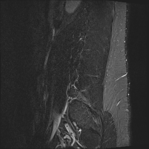 File:Normal lumbar spine MRI (Radiopaedia 47857-52609 Sagittal STIR 20).jpg
