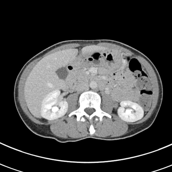 File:Normal multiphase CT liver (Radiopaedia 38026-39996 C 37).jpg