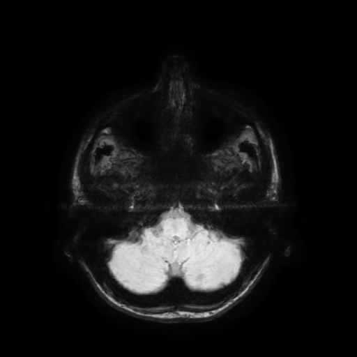 Normal noncontrast MR venography (Radiopaedia 87578-103957 Axial SWI 65).jpg