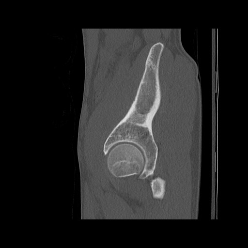 Normal pelvis (Radiopaedia 51473-57238 Sagittal bone window 112).jpg