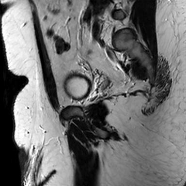 File:Normal prostate (MRI) (Radiopaedia 29986-30535 Sagittal T2 4).jpg