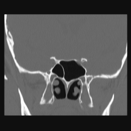 Normal sinus CT (annotated) (Radiopaedia 78917-91810 Coronal bone window 42).jpg