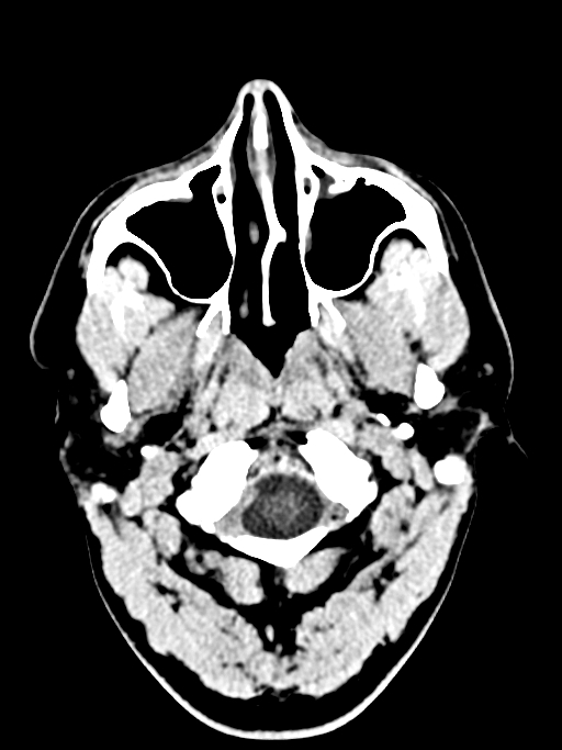 Normal trauma protocol brain and C-spine CT (Radiopaedia 83302-97709 Axial non-contrast 67).jpg