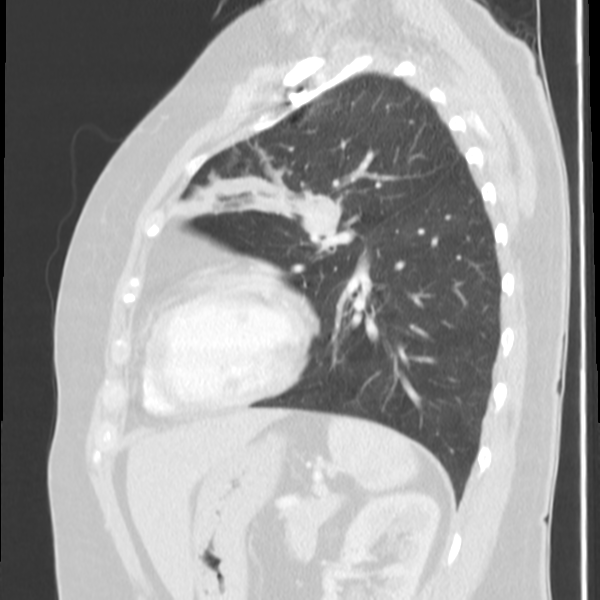 Obstructing typical carcinoid causing bronchoceles (Radiopaedia 50149-55476 Sagittal lung window 40).png