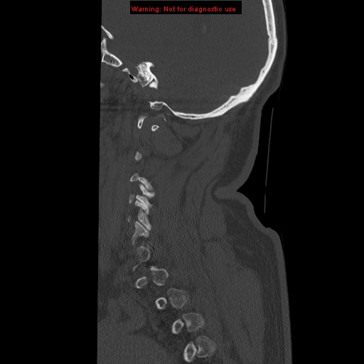 File:Occipital condyle fracture (Radiopaedia 18366-18208 Sagittal bone window 32).jpg