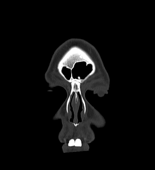 Occipital spur and Currarino type A atlas anomaly (Radiopaedia 87027-103285 Coronal bone window 25).jpg