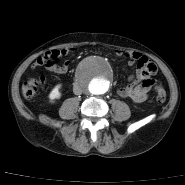 Abdominal aortic aneurysm (Radiopaedia 29248-29660 Axial C+ arterial phase 50).jpg