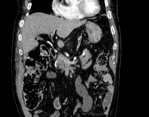 Abdominal aortic aneurysm (Radiopaedia 67117-76452 Coronal C+ arterial phase 18).jpg