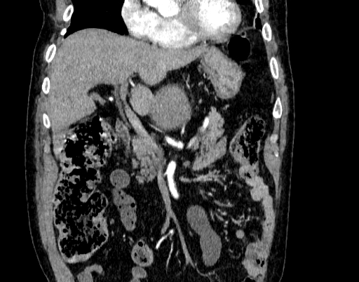 Abdominal aortic aneurysm (Radiopaedia 67117-76452 Coronal C+ arterial phase 22).jpg
