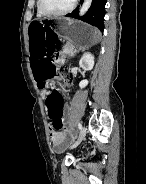 Abdominal aortic aneurysm (Radiopaedia 83581-98689 Sagittal C+ portal venous phase 84).jpg