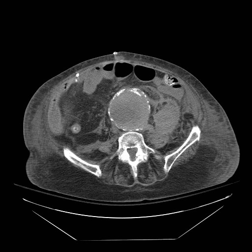 Abdominal aortic aneurysm - impending rupture (Radiopaedia 19233-19247 Axial non-contrast 108).jpg