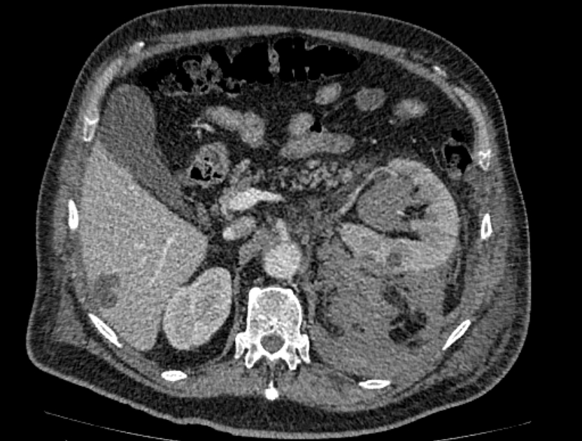 Abdominal aortic aneurysm rupture (Radiopaedia 54179-60362 Axial C+ portal venous phase 28).jpg