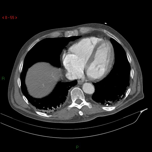 File:Abdominal aortic aneurysm rupture with aortocaval fistula (Radiopaedia 14897-14841 Axial C+ arterial phase 55).jpg