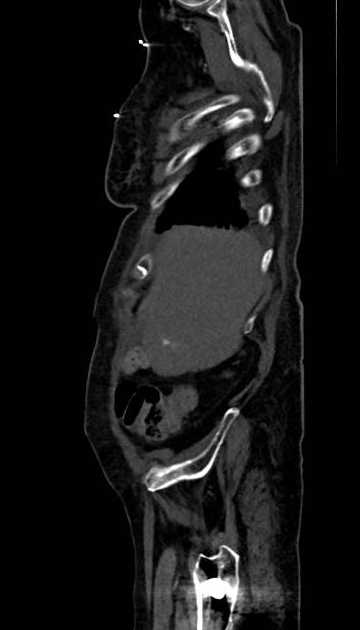 Abdominal aortic aneurysm with thrombus fissuration (Radiopaedia 73192-83919 Sagittal C+ arterial phase 126).jpg