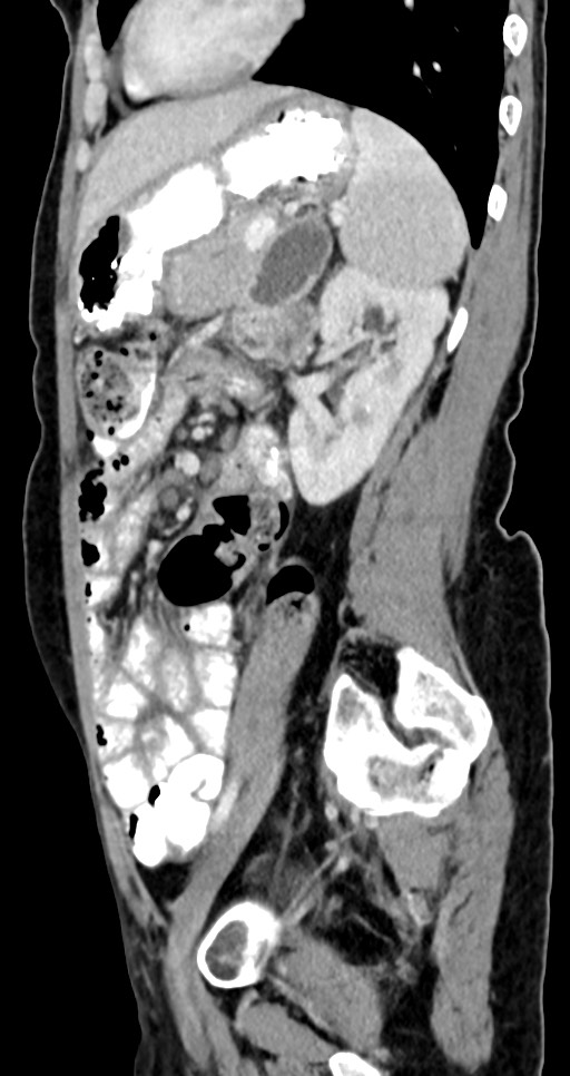 Abdominal wall and retroperitoneal tuberculosis (Radiopaedia 88137-104729 Sagittal C+ portal venous phase 52).jpg