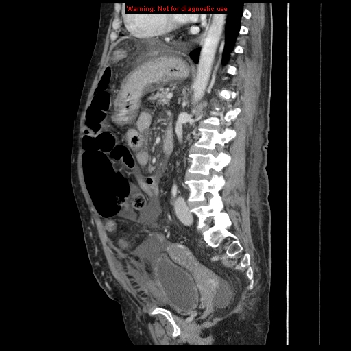 Abdominal wall hematoma (Radiopaedia 9427-10112 Sagittal C+ portal venous phase 45).jpg
