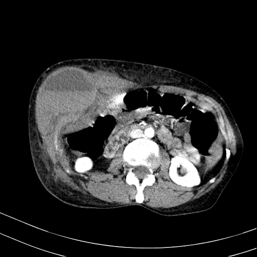 Abdominal wall hematoma with active bleeding (Radiopaedia 83915-99117 Axial renal cortical phase 36).jpg