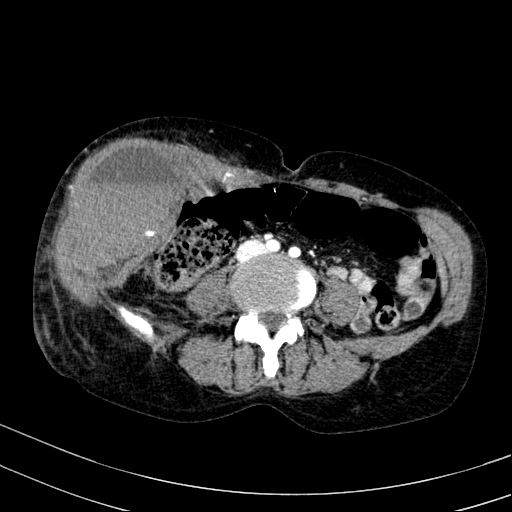 File:Abdominal wall hematoma with active bleeding (Radiopaedia 83915-99117 Axial renal cortical phase 67).jpg