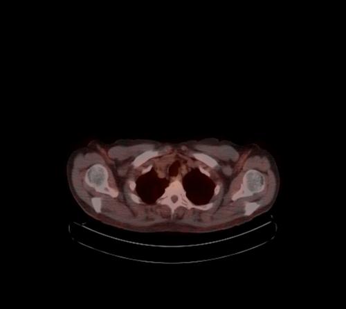 Abdominal wall metastasis from colorectal carcinoma (Radiopaedia 31016-31719 C 125).jpg