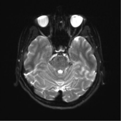 File:Abducens nerve palsy (Radiopaedia 51069-56648 Axial DWI 8).png