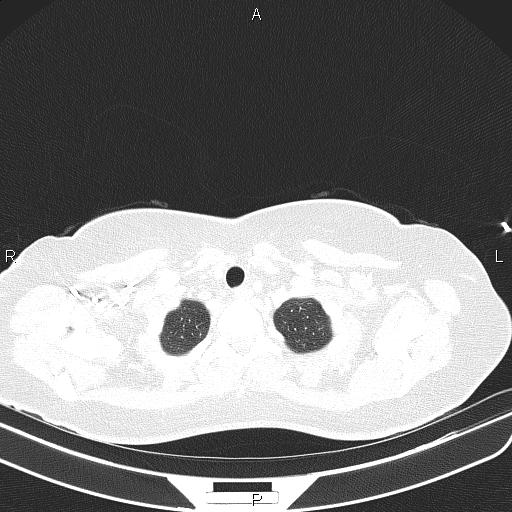 Aberrant right subclavian artery (Radiopaedia 87334-103629 Axial lung window 10).jpg