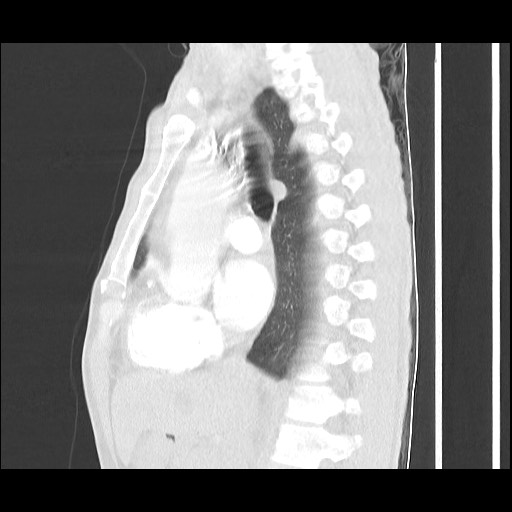 Accessory left horizontal fissure with lingular pneumonia (Radiopaedia 53763-59843 Sagittal lung window 33).jpg