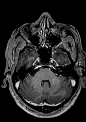 Accessory middle cerebral artery (Radiopaedia 73114-83828 Axial T1 C+ 123).jpg