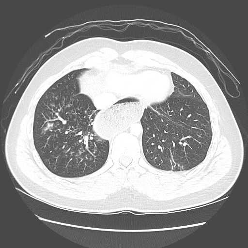 File:Achalasia (Radiopaedia 52507-58417 Axial lung window 48).jpg