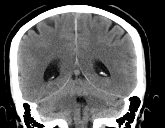 File:Acoustic schwannoma (Radiopaedia 33045-34065 Coronal non-contrast 30).png