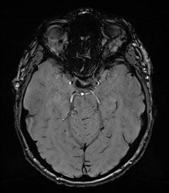 Acoustic schwannoma (Radiopaedia 50846-56358 Axial SWI 35).png