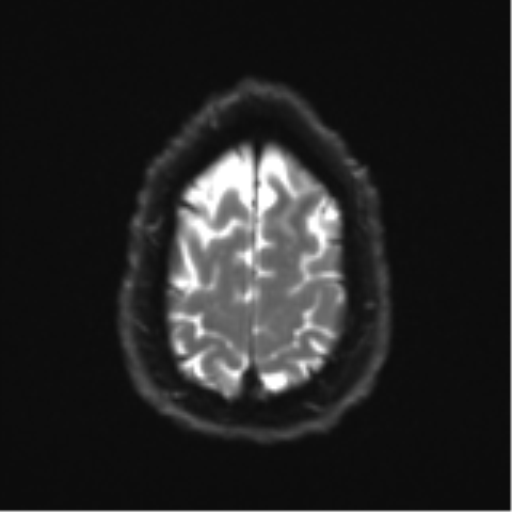 Acoustic schwannoma (Radiopaedia 55729-62281 E 25).png